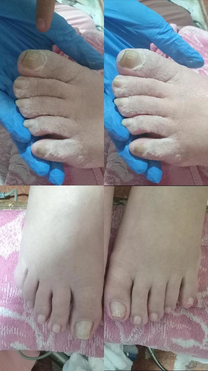 Педикюр  сложный педикюр