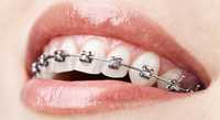 Aparat dentar cu bracketi metalici. Consultatii gratuite