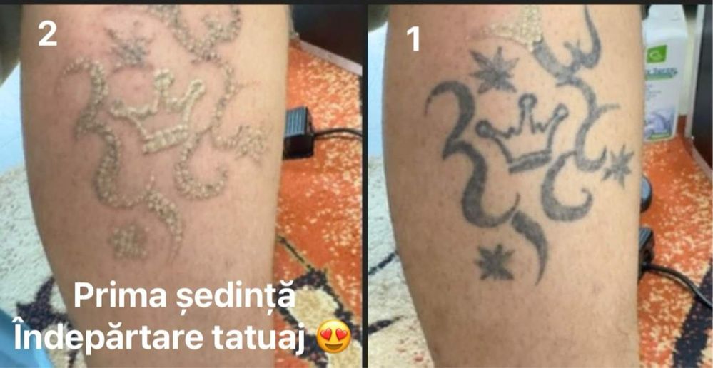 Indepartare tatuaje Laser Nd Yag