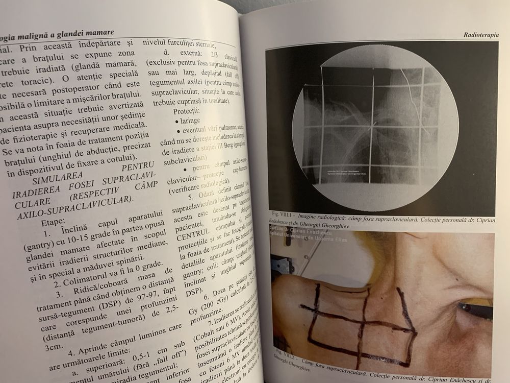 Tratat oncologie Patologia maligna a glandei mamare Prof Bădulescu