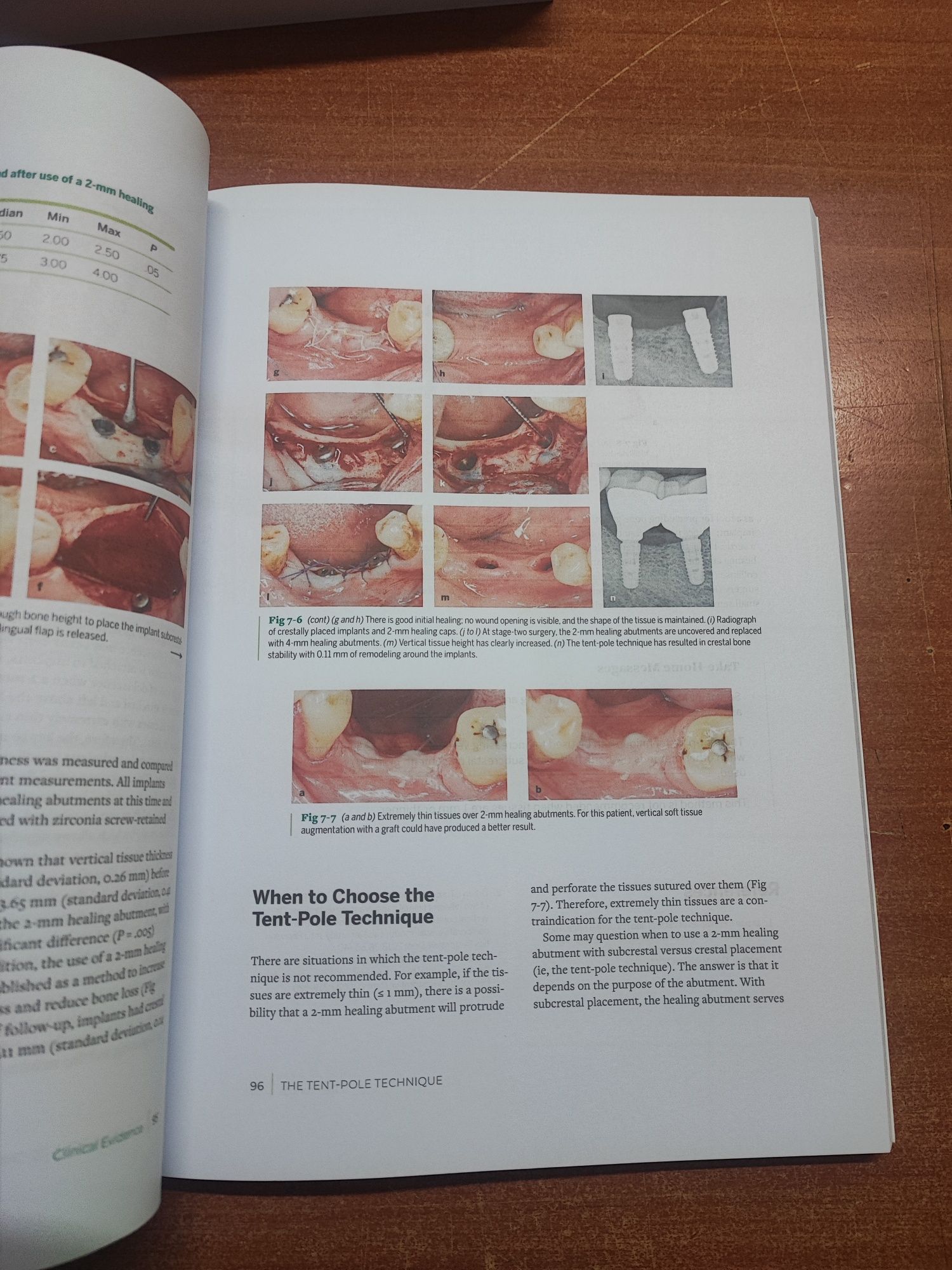 Zero bone loss concepts
zero bone loss concepts