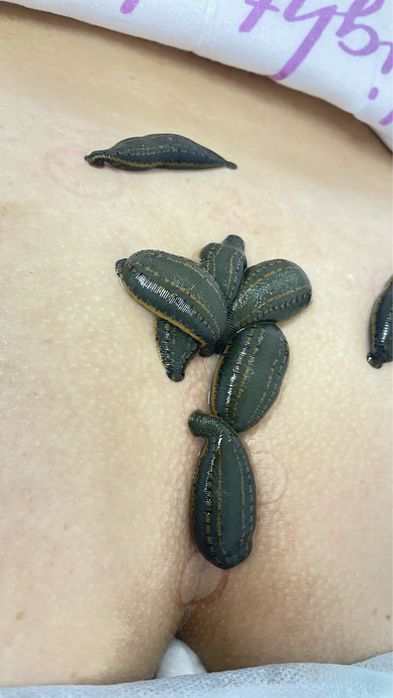 Лечение пиявками, сүлікпен емдеу