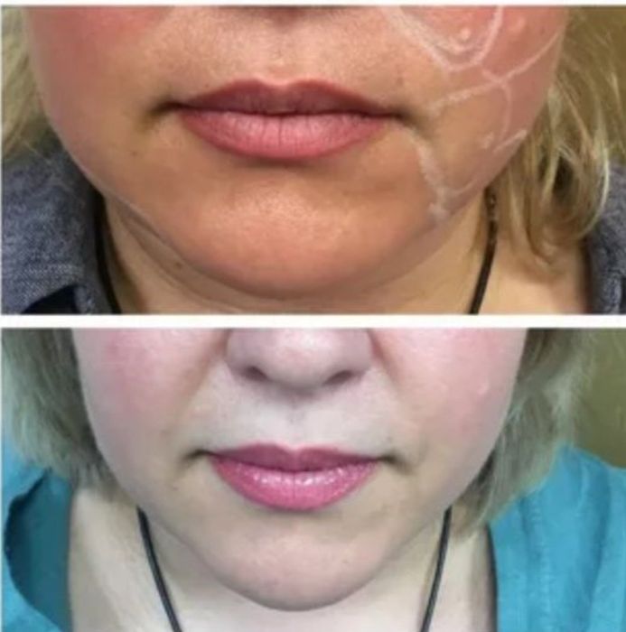 Сжиросжигающий коктейль. Лицо, второй подбородок. Тело