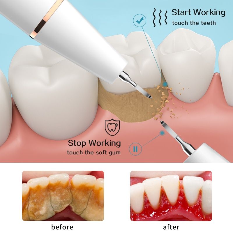 Ультразвуковой скалер (чистка) зубов от зубного камня, налёта
