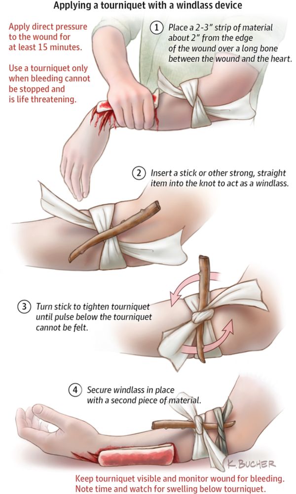 тактически турникет за първа помощ най бързото спиране на кръвозагуба