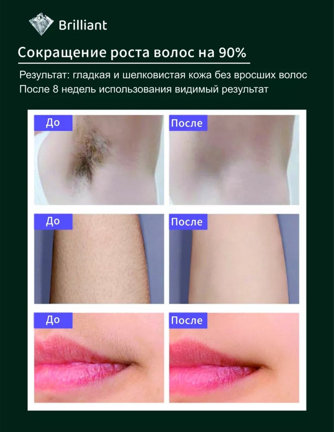 Профессиональный фотоэпилятор с системой охлаждения