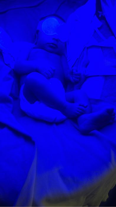 Фотолампа - кювез от желтушки