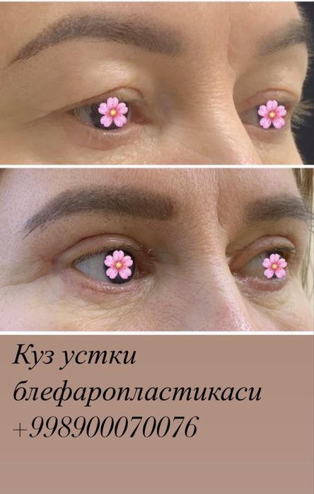 Блефаропластика и броулифтинг