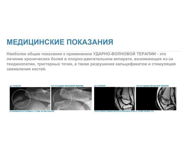 Аппарат фокусированной ударно-волновой терапии