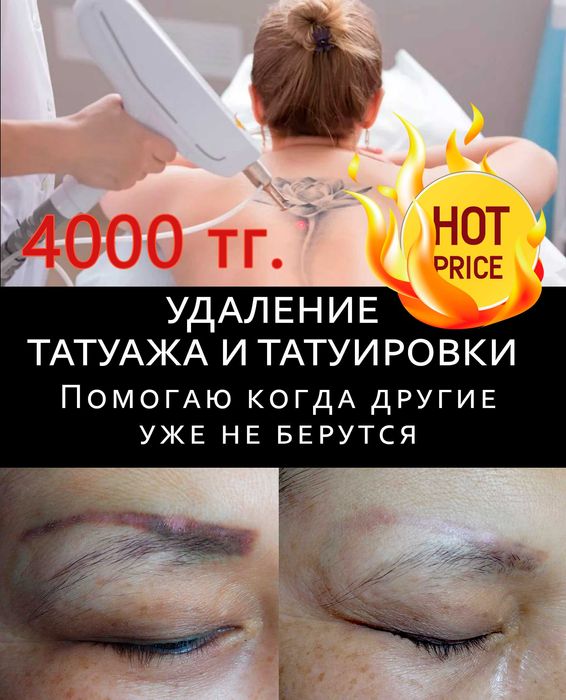 Лузерное даление татуажа, ремувер