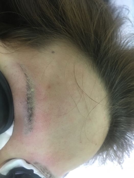 Удаление татуажа лазером 3000