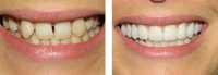 Протез стоматолог 24/7 стоматология металлокерамика протез винир