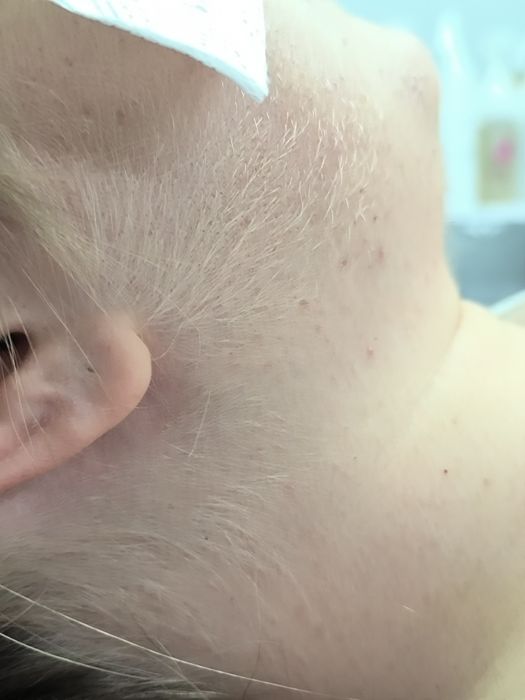 Акция Депиляция Шугаринг