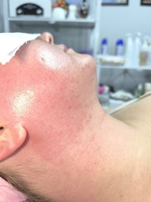 Акция Депиляция Шугаринг