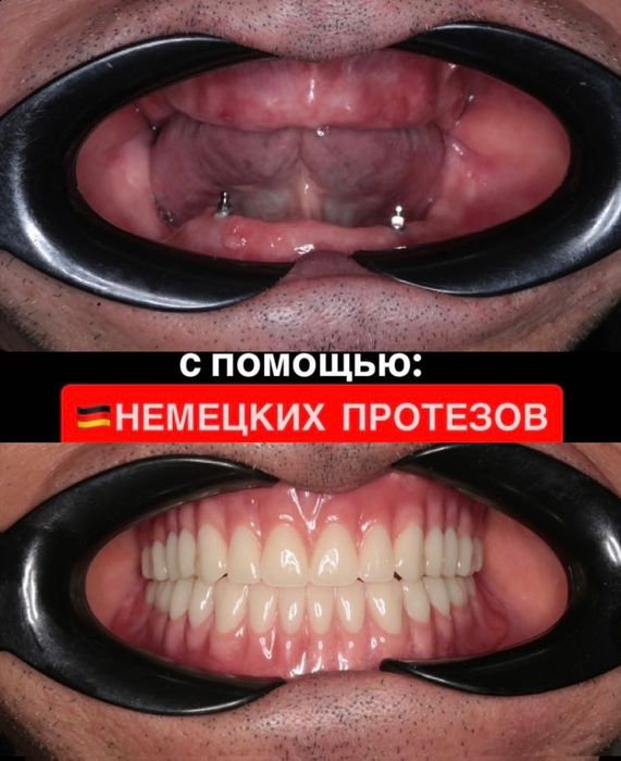 Протез. Съемные протезы. Зубные протезы. Стоматология протезы
