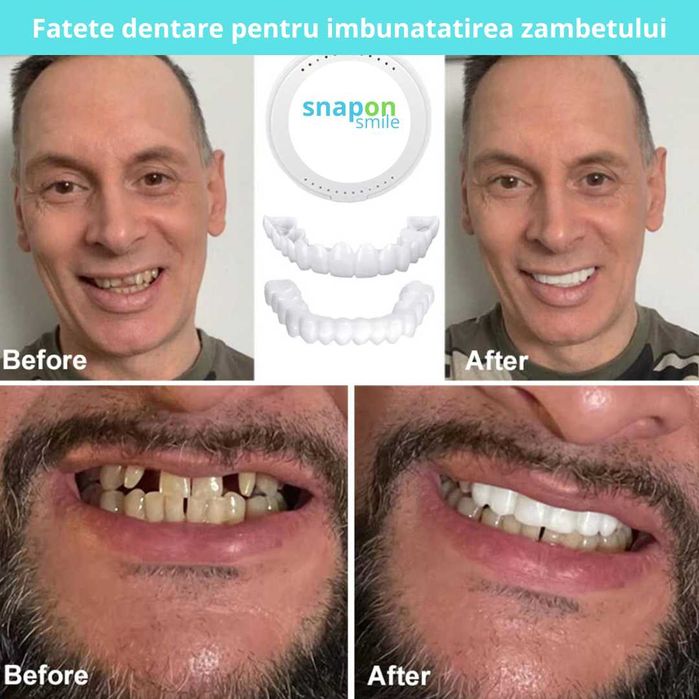 Fațete Dentare Cosmetice SnapSmile – Zâmbet Alb Instant, Reutilizabile