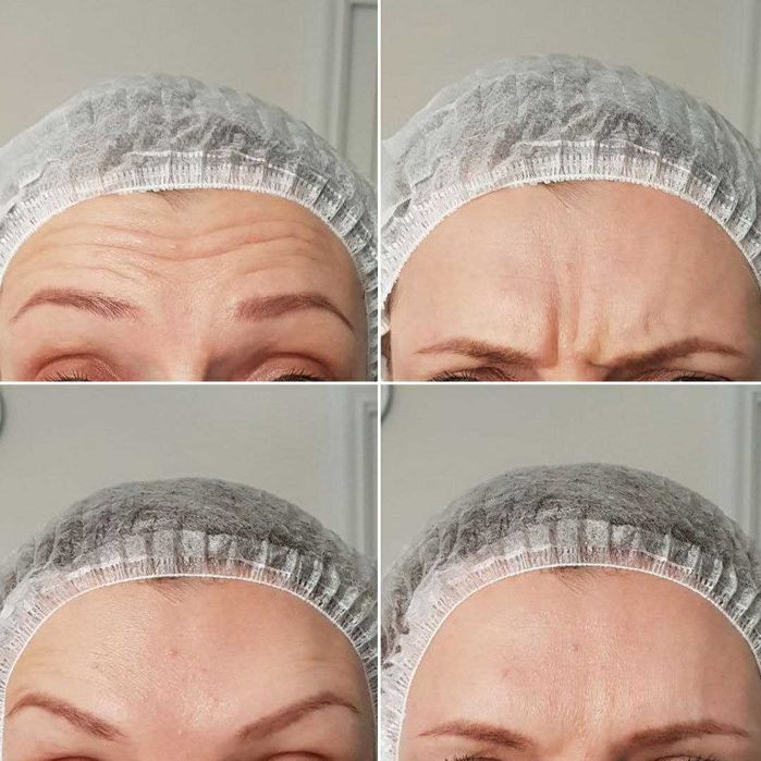 Ботокс от морщин в Ташкенте. Убираем морщины без операций.