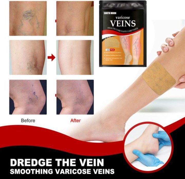 Varicose veins patch ,,,varikoz 12 sht plaster optom