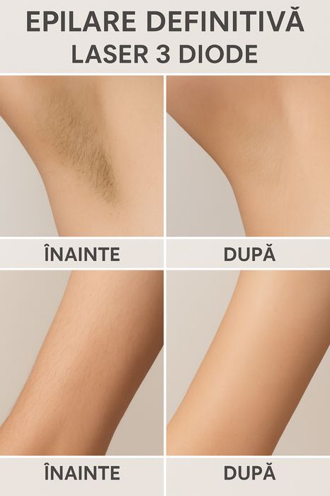 Epilare definitivă cu laser Nd-YAG și Alexandrite Sector 4