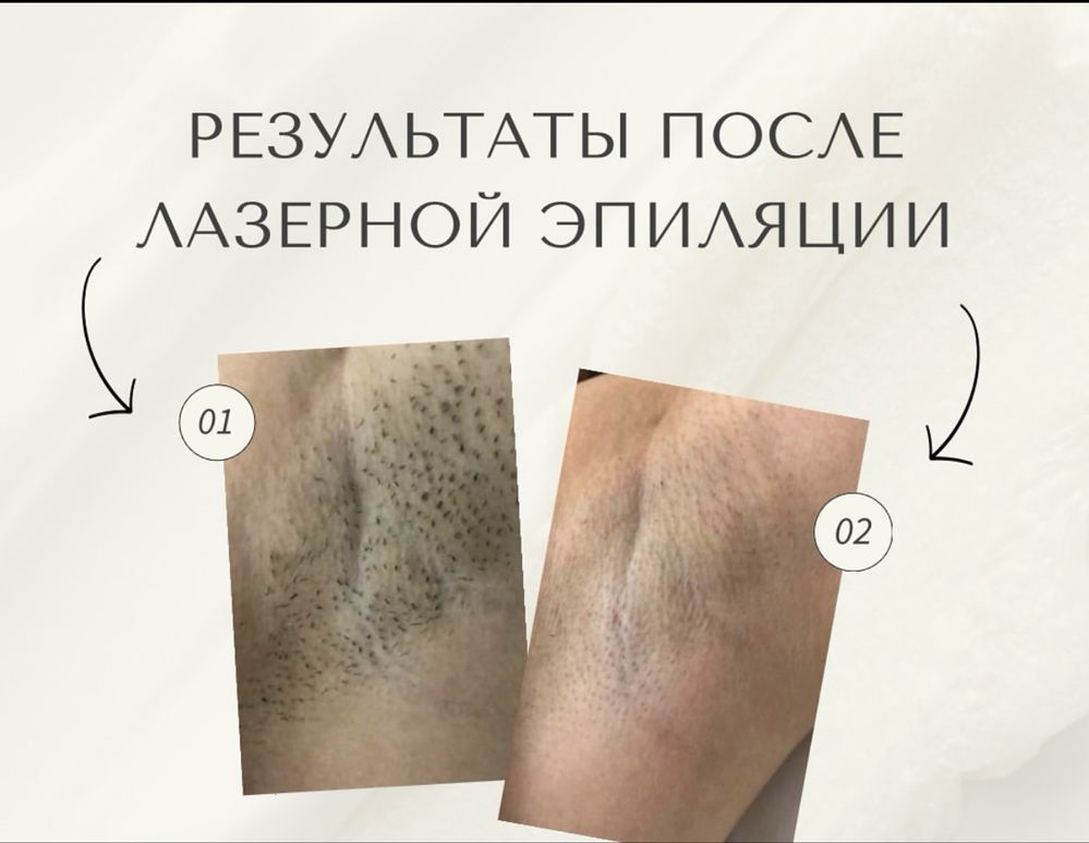 Скидки! Лазерная эпиляция
