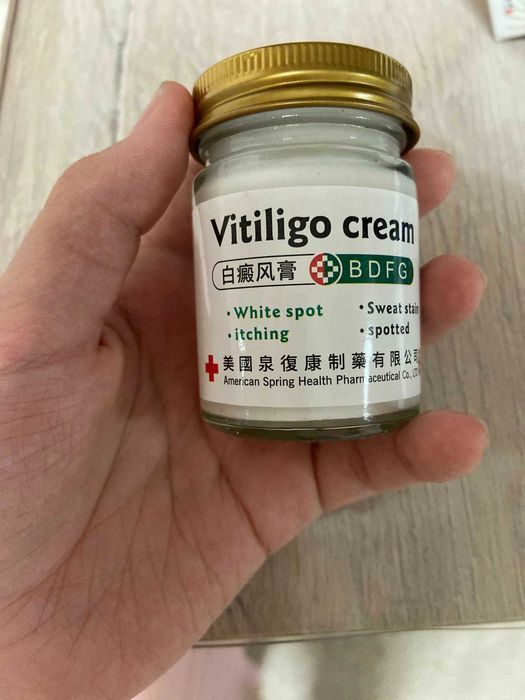 Vitiligo kremi oq doglarga qarshi
