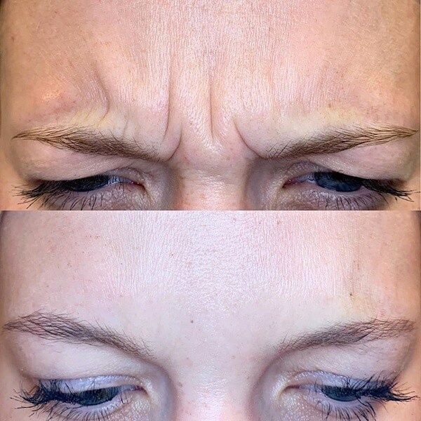 Ботокс Кореи, Япония.