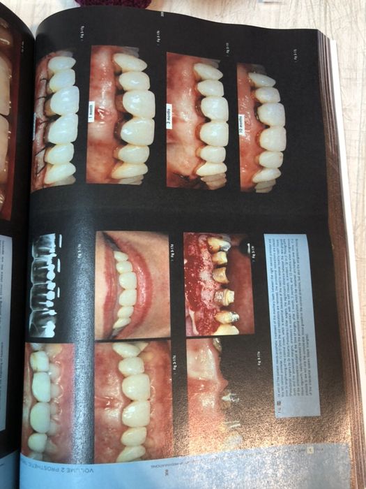 Esthetic Rehabilitation in Fixed Prosthodontics, Volume 1 & 2 FRADEANI