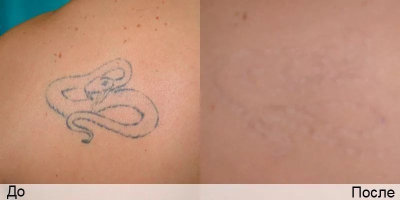 Лазерное удаление тату, татуировок, наколок и татуажа бровей недорого