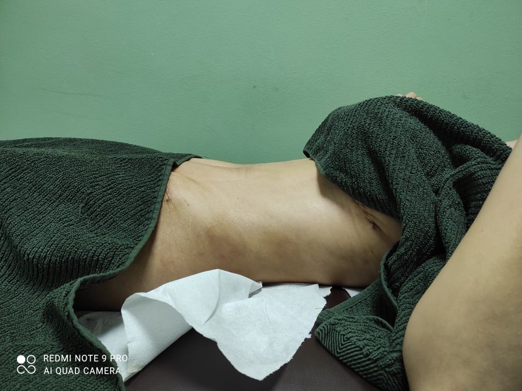 Drenaj limfatic manual post opertor bbl , liposuctie , abdominoplastie