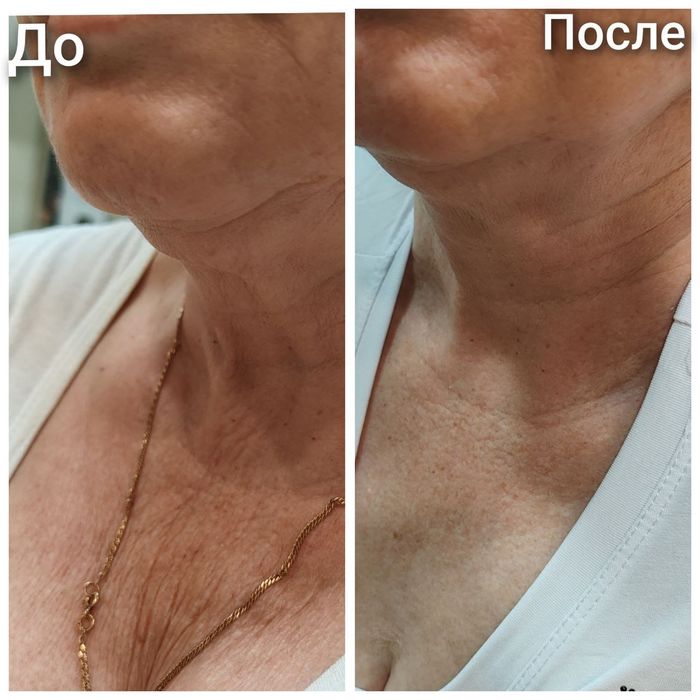 Чистка,  пилинг, мезотерапия, ботокс