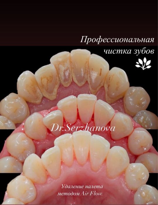 Жду вас на профессиональную чистку зубов!