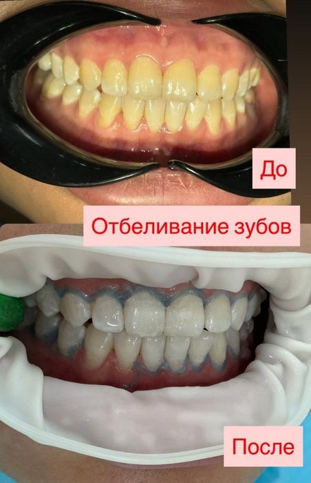 Oertodont Breket quyish xizmati
