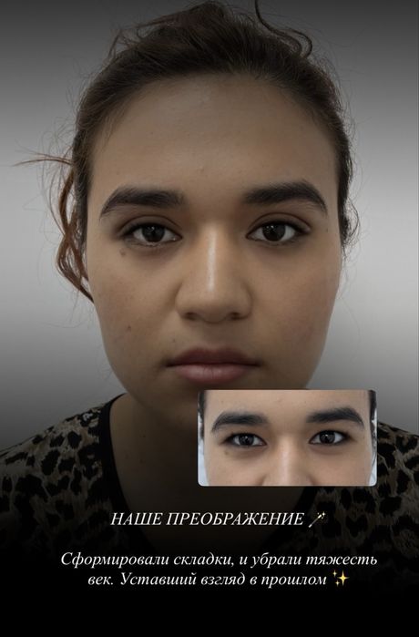 НИТЕВАЯ блефаропластика сангапруи