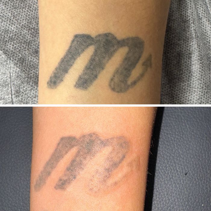 Stergere tatuaje cu laser nd:Yag