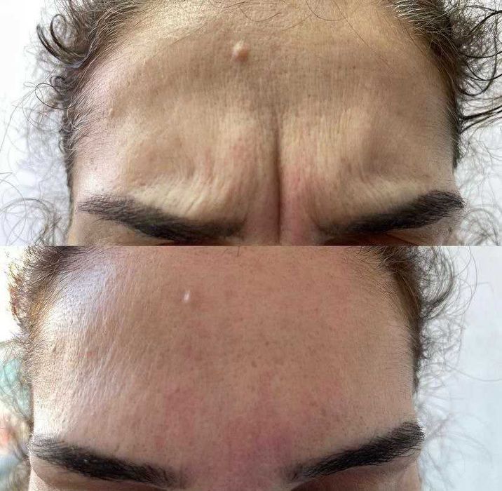 Ботокс от морщин в Ташкенте. Убираем морщины без операций.