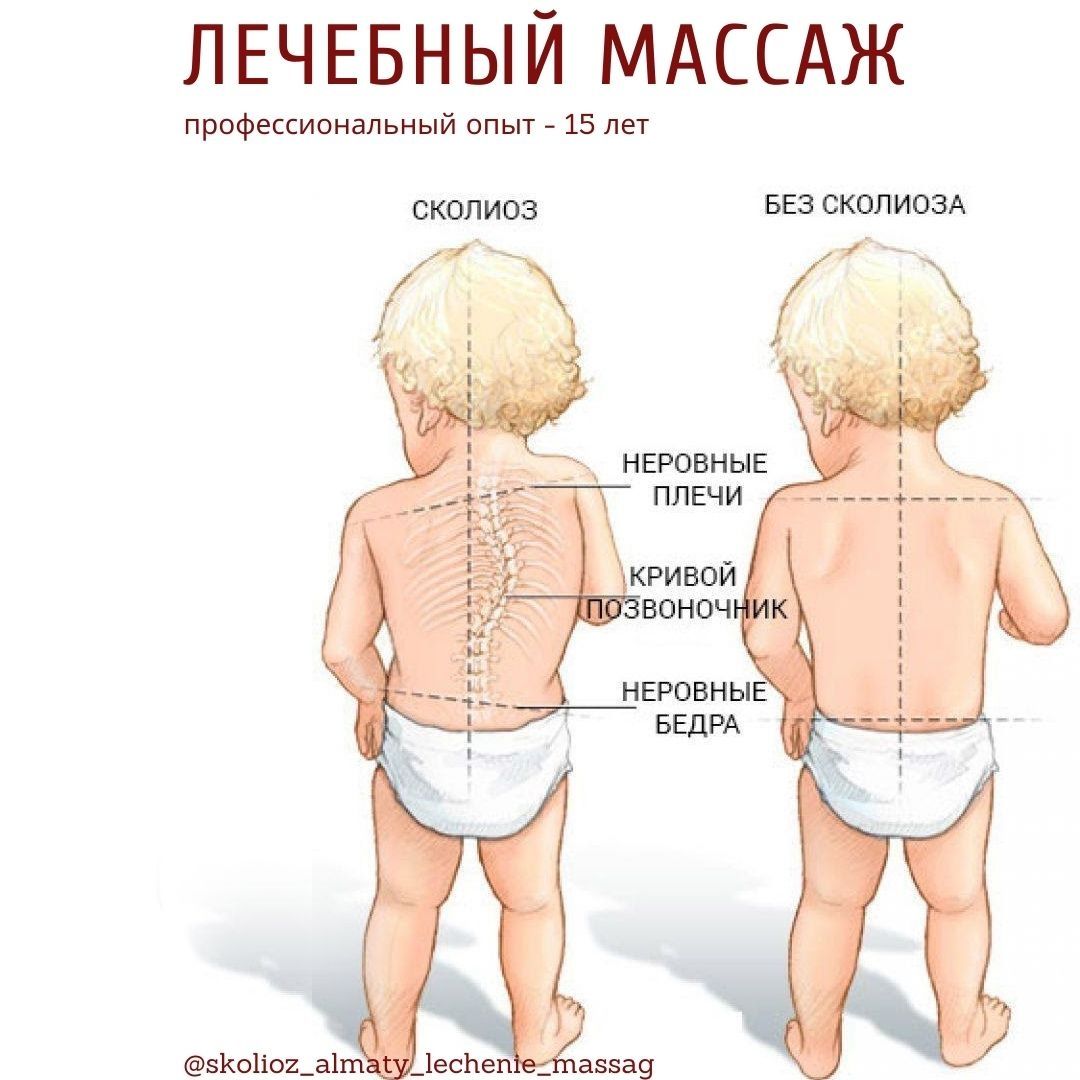 Грыжа позвоночника. Боли в спине,  пояснице, ШВЗ. Сколиоз