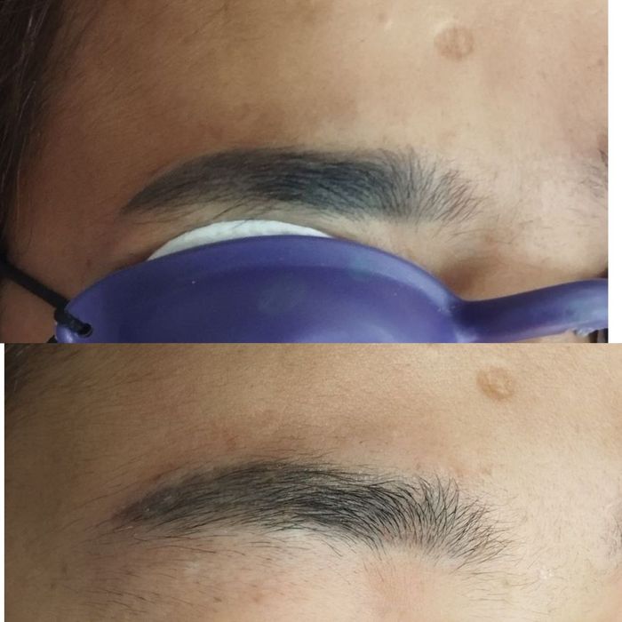 Удаление старого татуажа