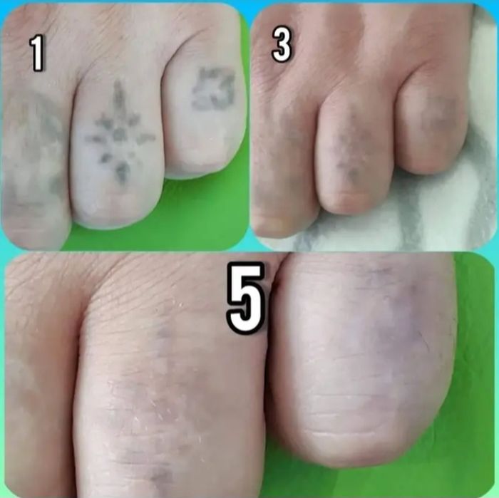 Удаления татуировок татуажа