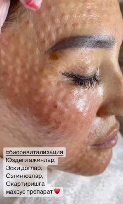 Лабиопластика,Броулифтинг,Блефаропластика.