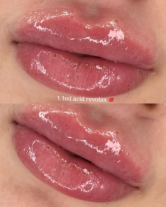 Marirea Buzelor cu Acid Hyaluronic