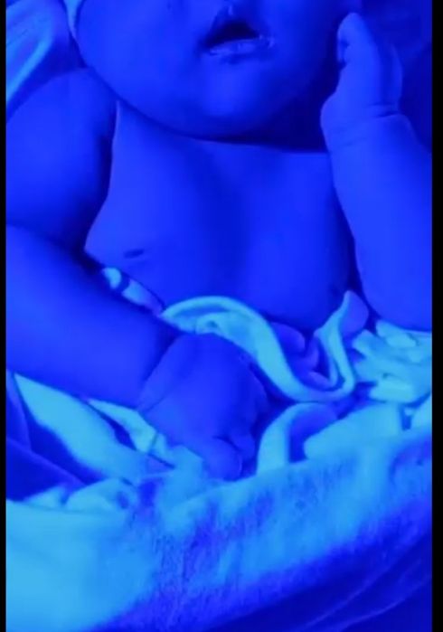 Fotolampa chaqaloqlardagi sariqlikni yo'qotish uchun fototetapiya