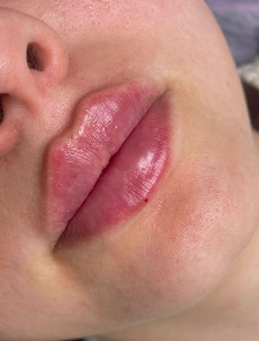 50% chegirmada blefaroplastika