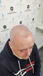 Micropigmentare scalp