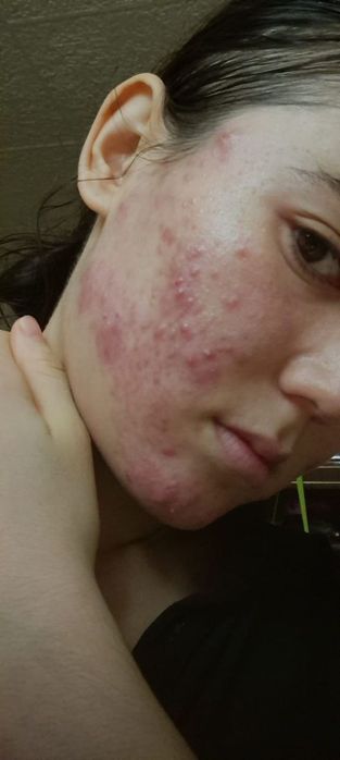 Muammoli yuzlar uchun maxsus to‘plam