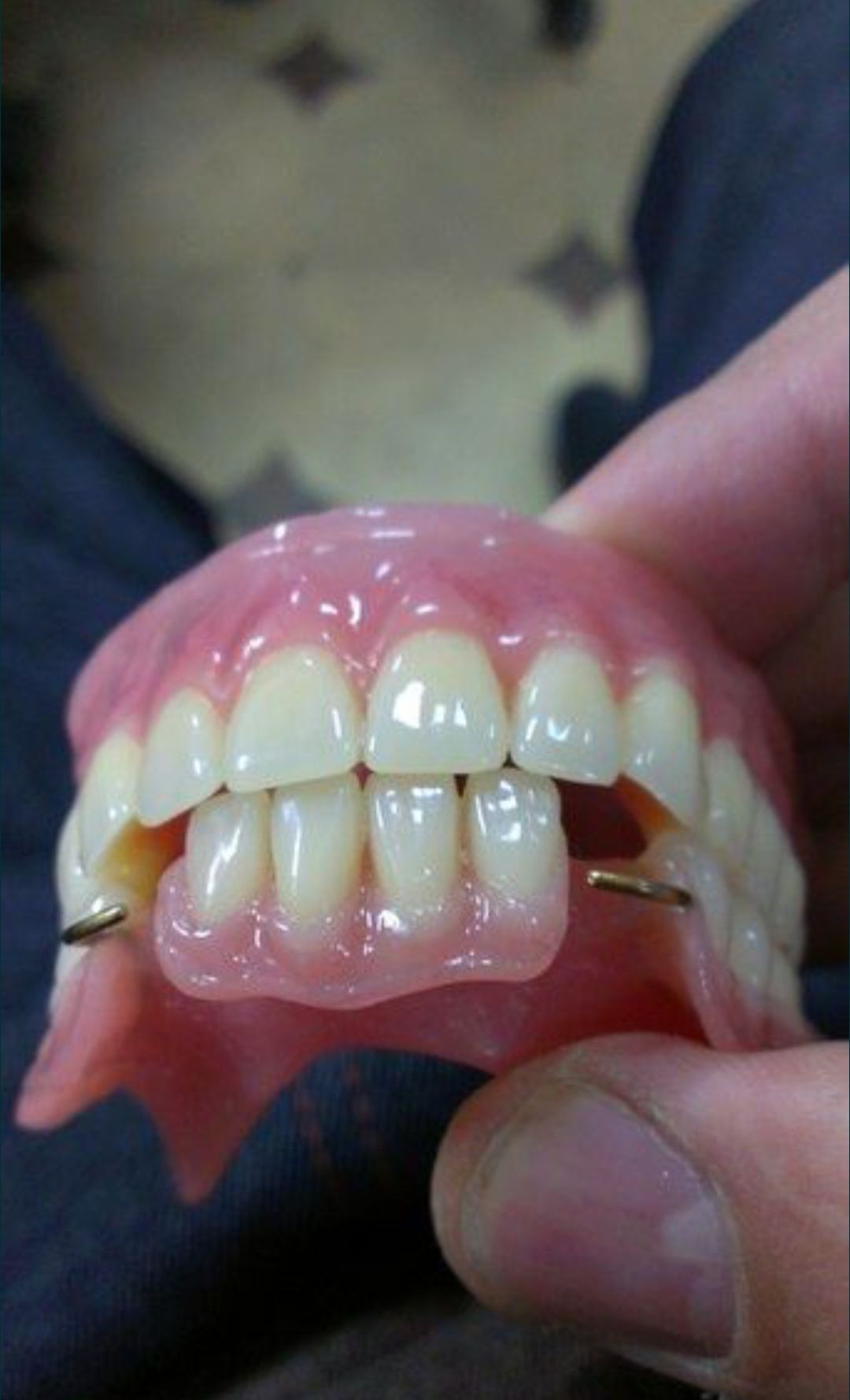 Съёмные зубные протезы