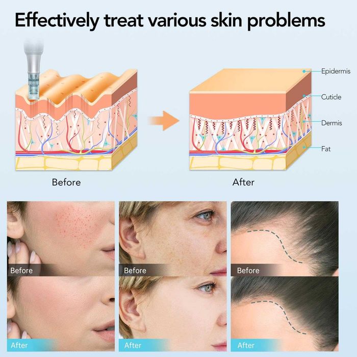 Dr. Pen Микронидлинг писалка M7S 2025 с 18 патрона, 6 скорости