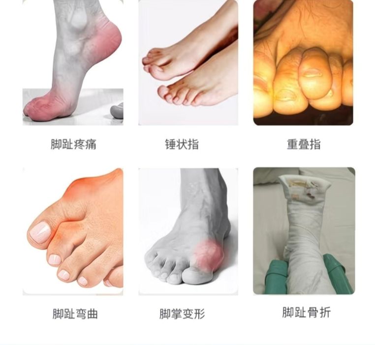 Ортез фиксатор для пальцев ног вместо гипса бандаж для всех пальцев