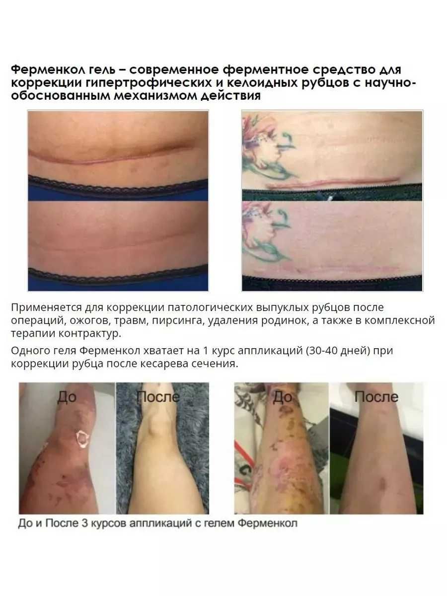 Ферменкол гель косметический от рубцов и шрамов. Объем 30г.