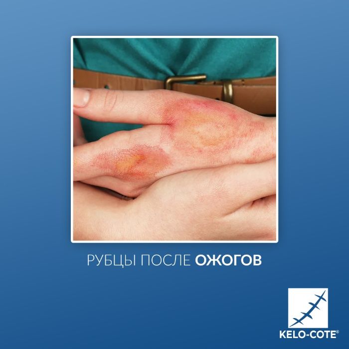 Kelo-Cote 10g-15g-60g- силиконовый гель для рассасывания рубцов