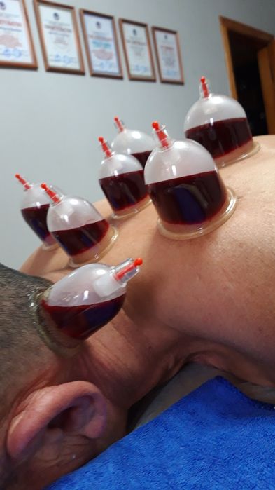 Хиджама. Шертпе. Пиявки